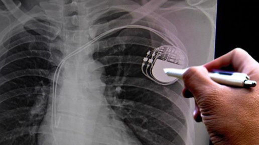 Картинка: Медицинское страхование и кардиостимуляторы