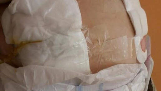 Картинка: В Благовещенске после операции пациентов из-за нехватки лейкопластыря перевязали канцелярским скотчем.