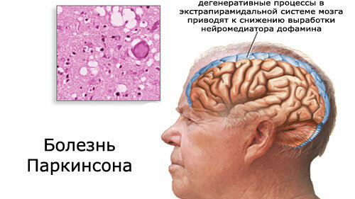 Картинка: Эффективное лечение болезни Паркинсона