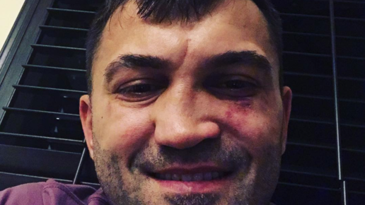 Картинка: Чемпиону UFC сломали нос в ресторане
