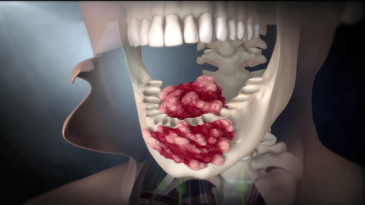 Картинка: Рак полости рта. Как заметить первые тревожные симптомы?