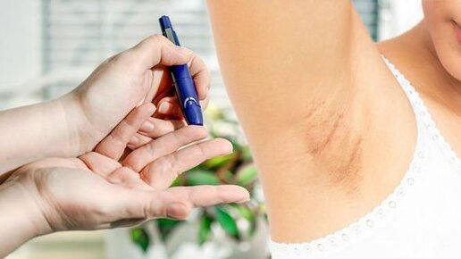 Картинка: Симптомы сахарного диабета: обратите внимание на этот знак в своих подмышках