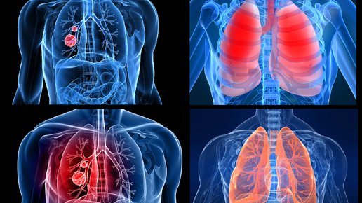 Картинка: Рак Лёгких и его необычные симптомы (