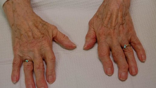 Картинка: Для людей от 40 до 65 лет: Виды остеоартроза и его причины