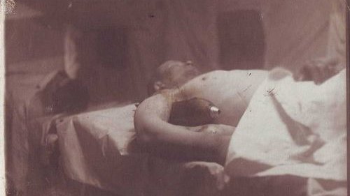 Картинка: На мой взгляд, фотография  человека с застрявшей в теле неразорвавшейся миной является фейковой