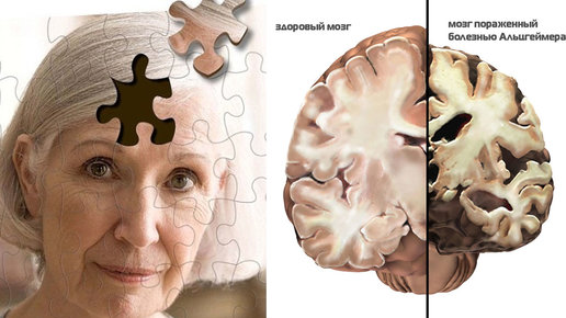 Картинка: Как диагностировать болезнь Альцгеймера?