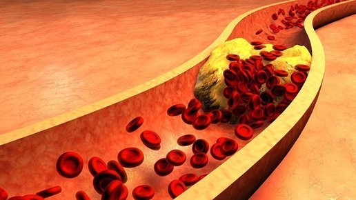 Картинка: 5 симптомов предельного уровня холестерина в крови 